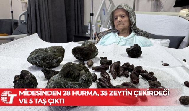 Midesinden 28 hurma, 35 zeytin çekirdeği ve 5 taş çıktı